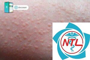 rôm sảy ở người lớn