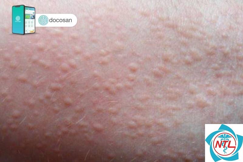 rôm sảy ở người lớn