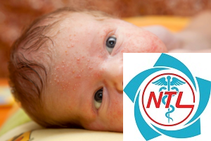 rôm sảy ở trẻ nhỏ