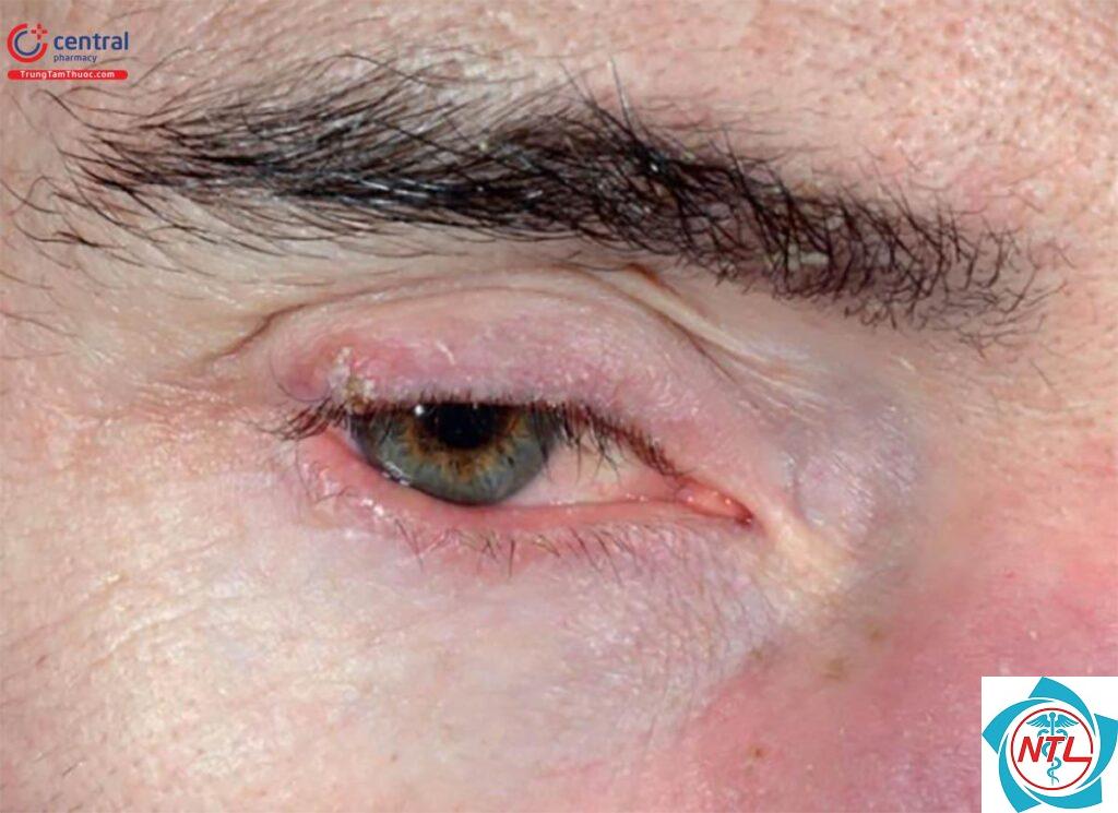 rosacea mắt