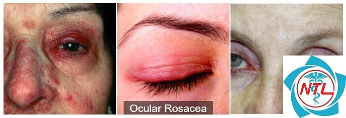 rosacea mắt - Image 2