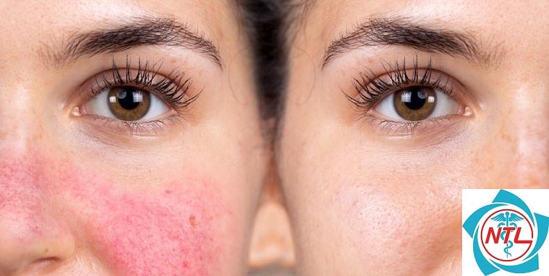 rosacea mắt - Image 3