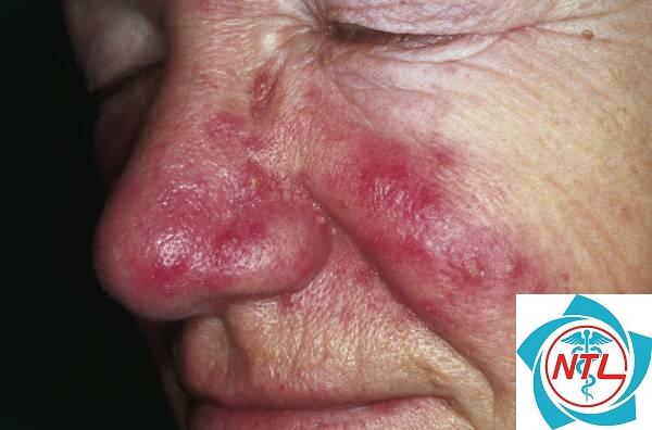 rosacea mắt - Image 4