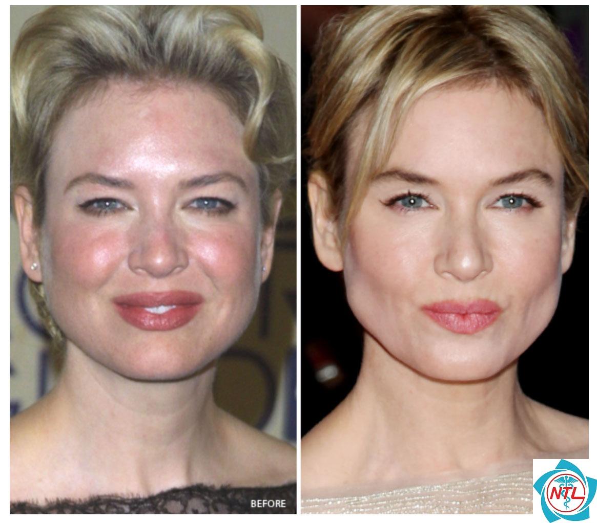 rosacea mắt - Image 5