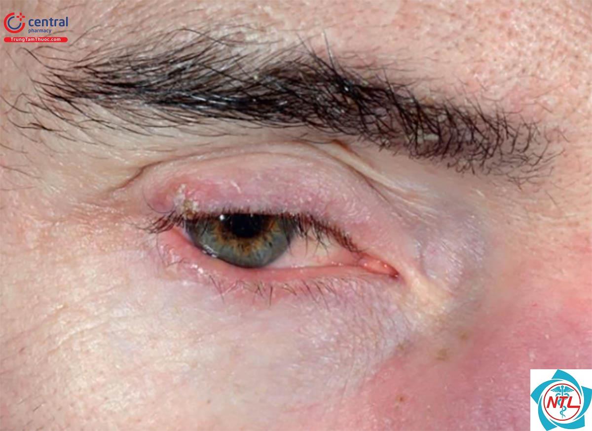 rosacea mắt - Image 1