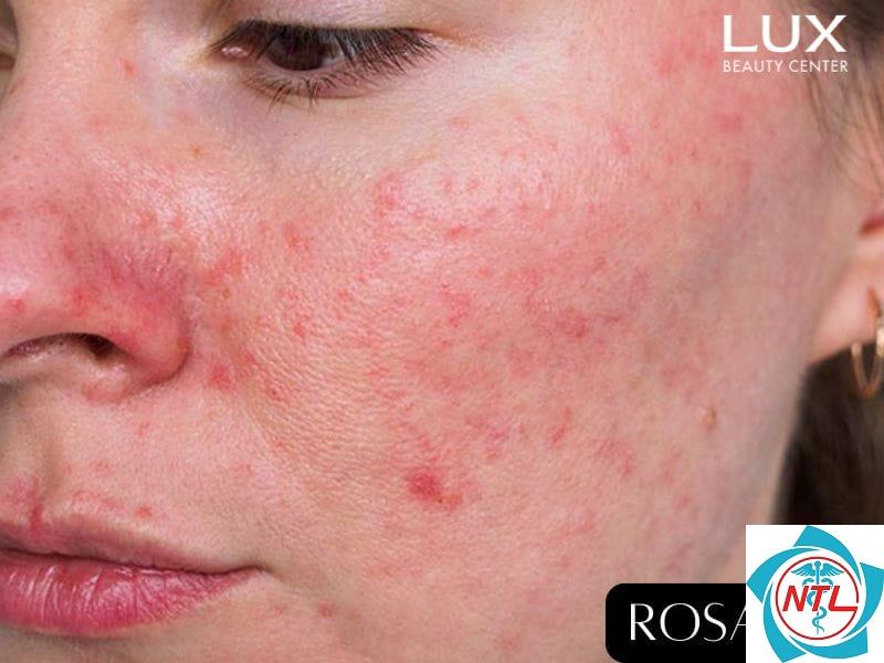 rosacea ở mặt - Image 3