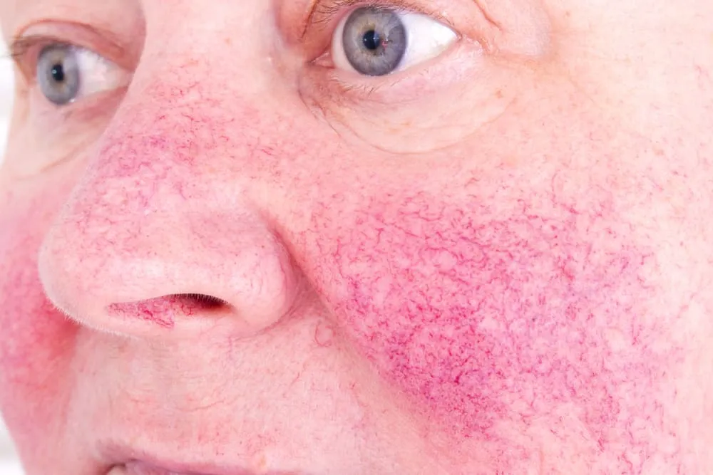 rosacea ở mặt - Image 4