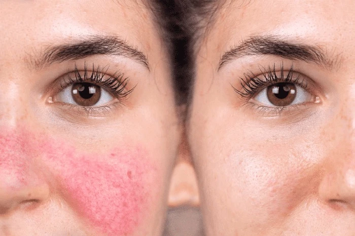 rosacea ở mặt - Image 5
