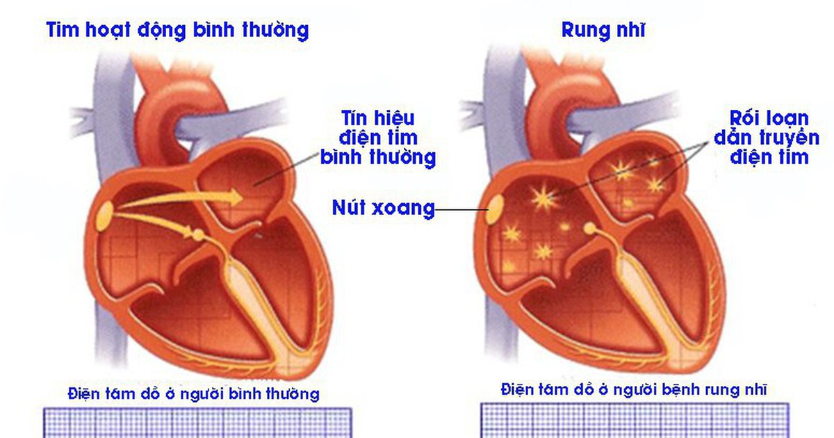 rung nhĩ - Image 5