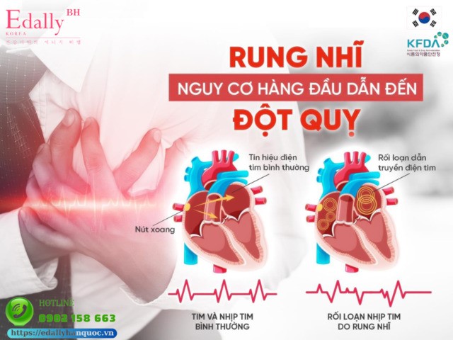 rung nhĩ và nguy cơ đột quỵ - Image 2