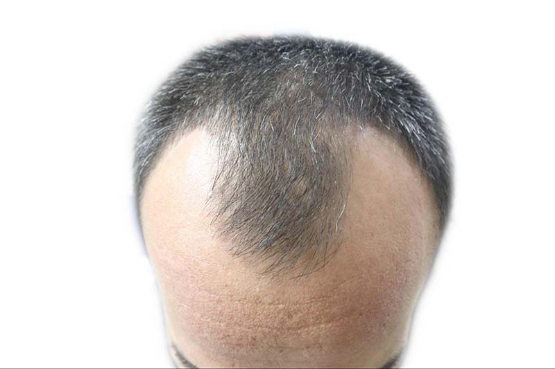 rụng tóc di truyền - Image 2