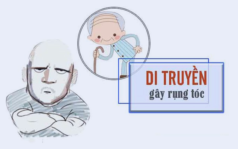 rụng tóc di truyền - Image 3