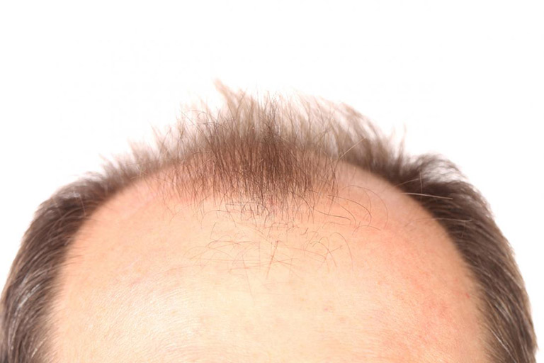 rụng tóc di truyền - Image 4