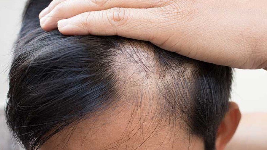 rụng tóc di truyền