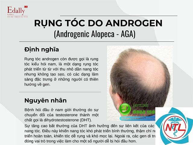 rụng tóc do androgen - Image 2