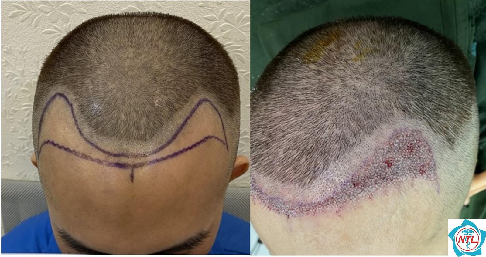 rụng tóc do androgen - Image 3