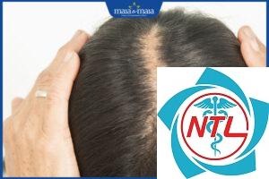 rụng tóc do androgen