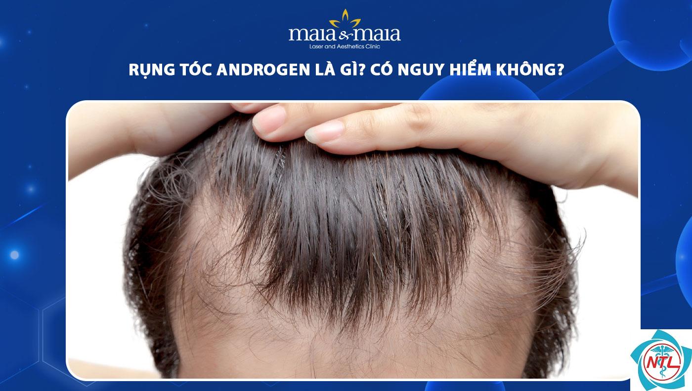 rụng tóc do androgen - Image 4