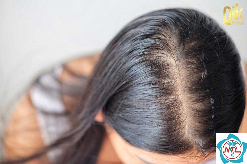 rụng tóc do androgen - Image 5