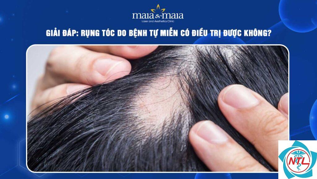rụng tóc do bệnh tự miễn