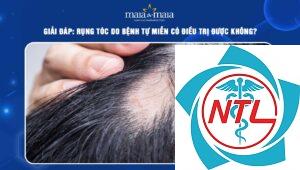 rụng tóc do bệnh tự miễn