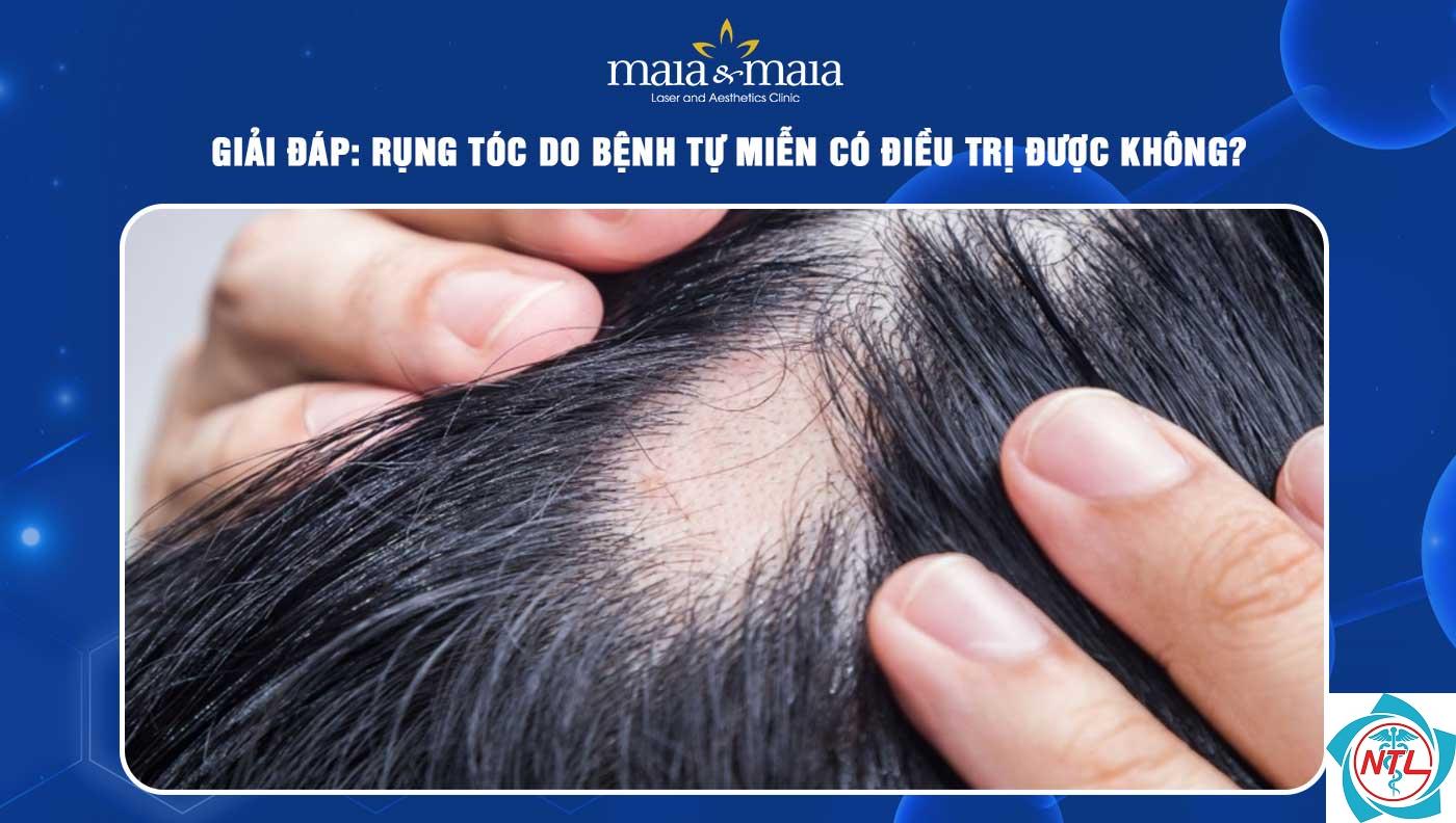 rụng tóc do bệnh tự miễn - Image 1
