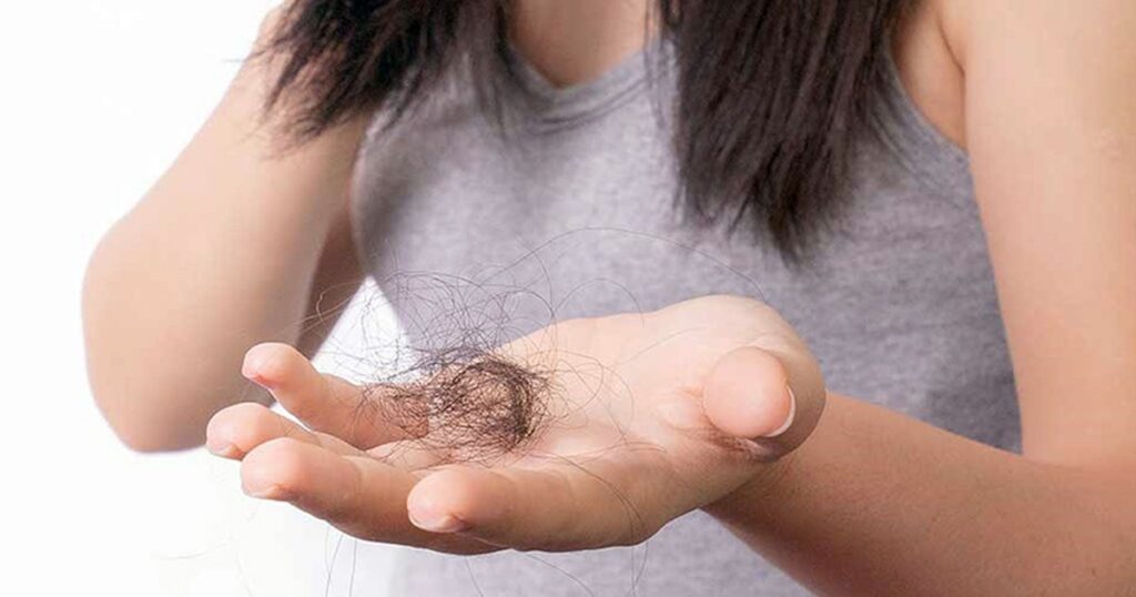 rụng tóc do bệnh tuyến giáp