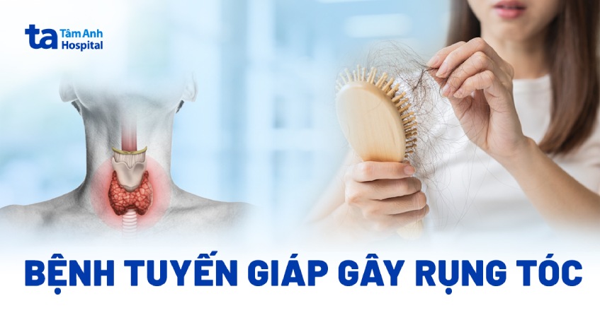 rụng tóc do bệnh tuyến giáp - Image 2