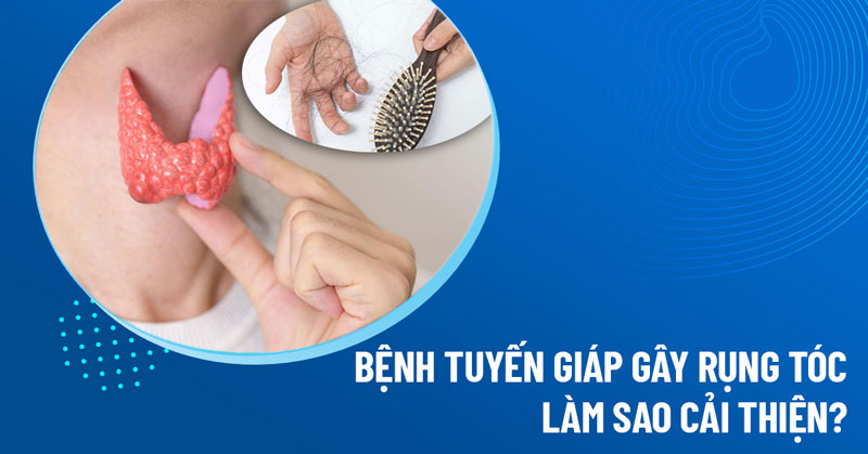 rụng tóc do bệnh tuyến giáp - Image 5