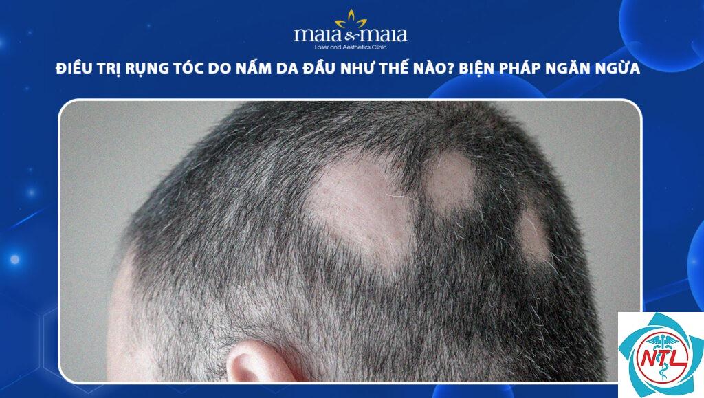 rụng tóc do nấm da đầu - Image 4