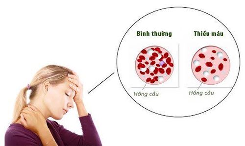 rụng tóc do thiếu máu - Image 3