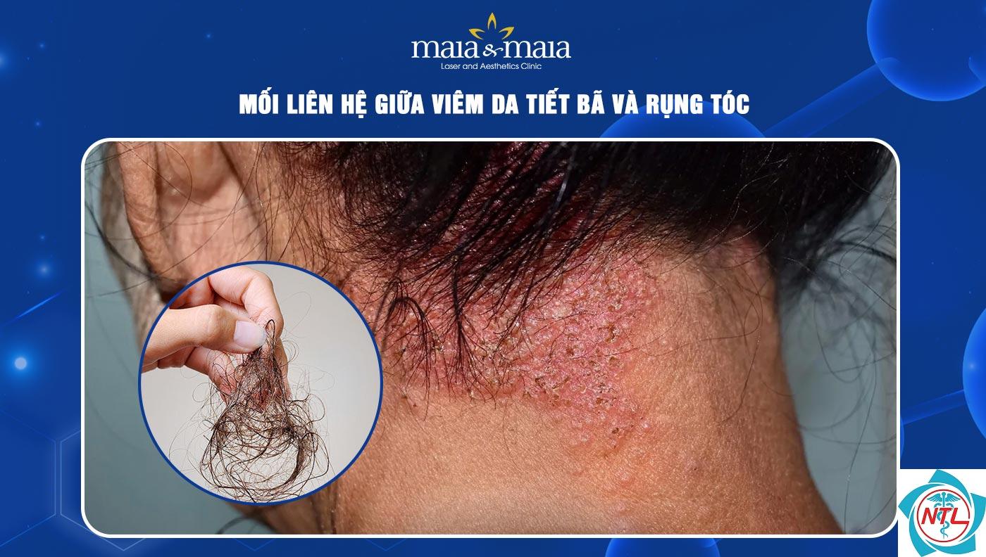 rụng tóc do viêm da đầu - Image 2