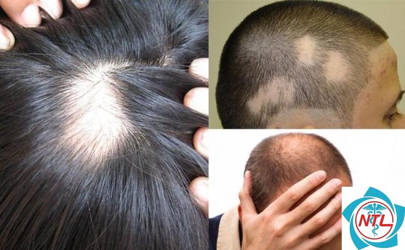 rụng tóc do viêm da đầu - Image 4