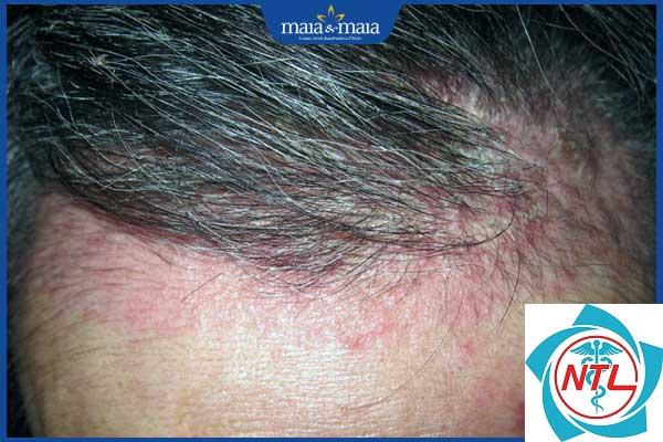 rụng tóc do viêm da đầu - Image 5