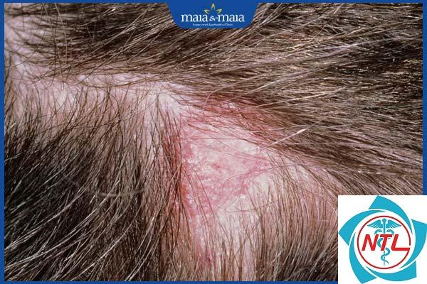 rụng tóc do viêm da đầu