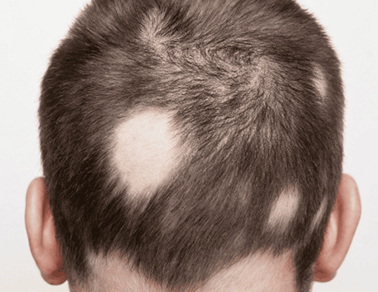 rụng tóc đột ngột - Image 2