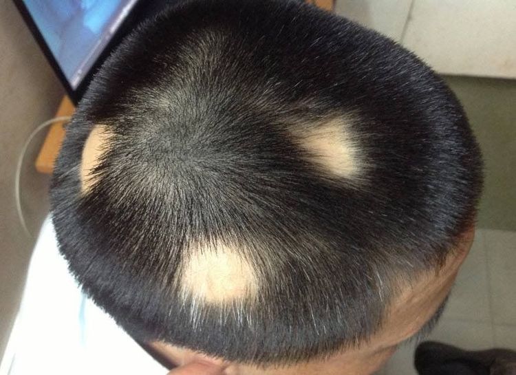 rụng tóc đột ngột - Image 4
