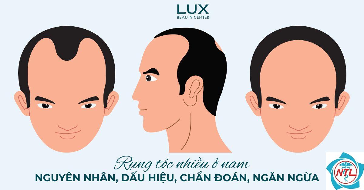 rụng tóc kiểu nam - Image 4
