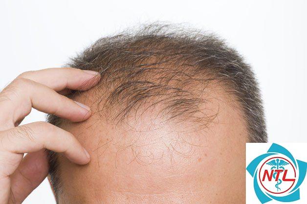 rụng tóc kiểu nam