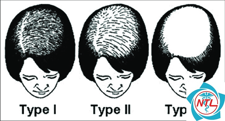 rụng tóc kiểu nữ - Image 2