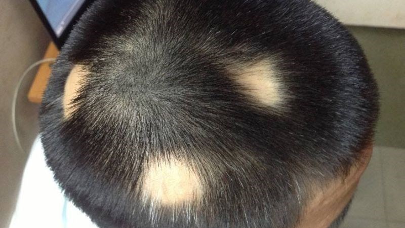 rụng tóc ở nam giới - Image 5