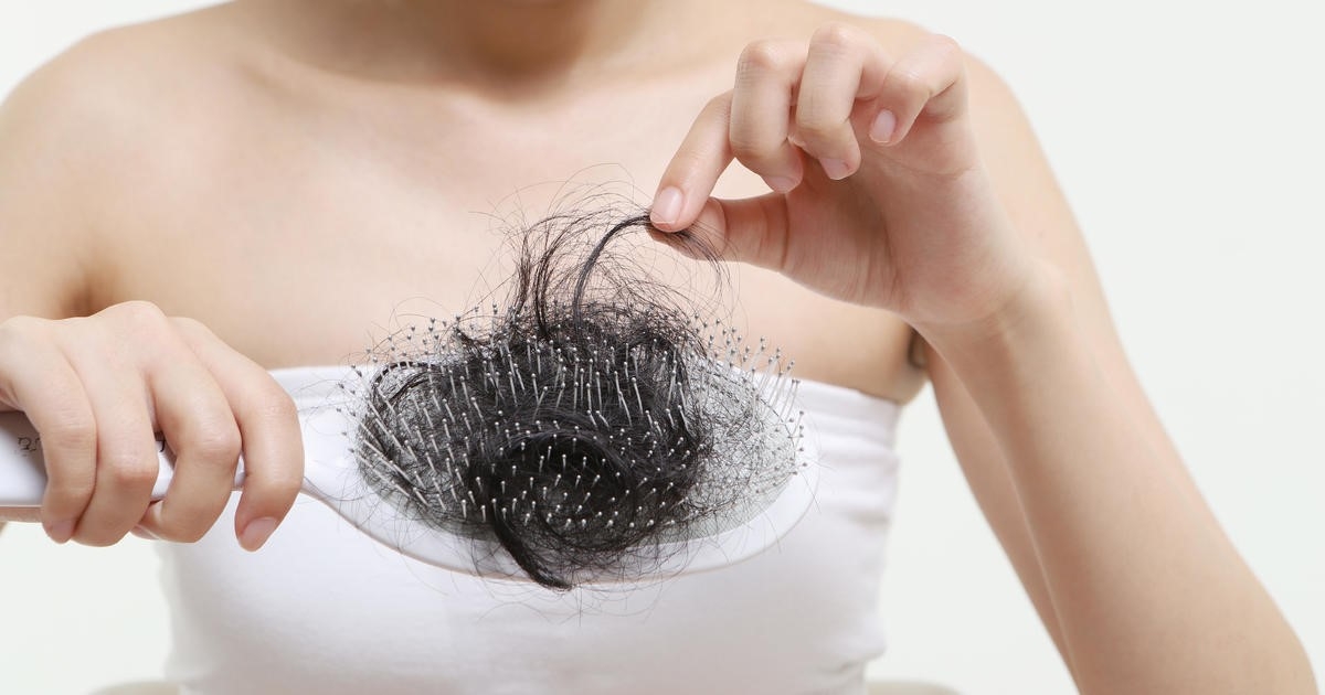 rụng tóc ở phụ nữ - Image 2
