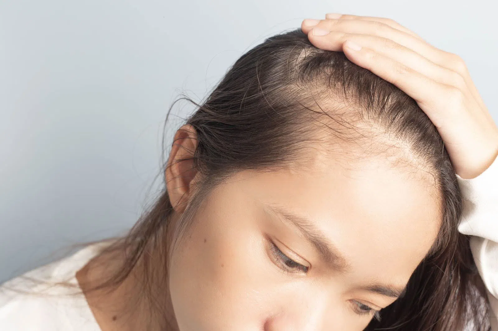 rụng tóc ở phụ nữ - Image 3