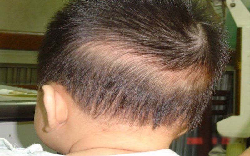 rụng tóc ở trẻ em - Image 4