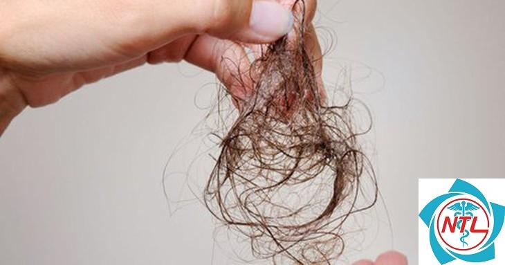 rụng tóc sau nhiễm virus - Image 3