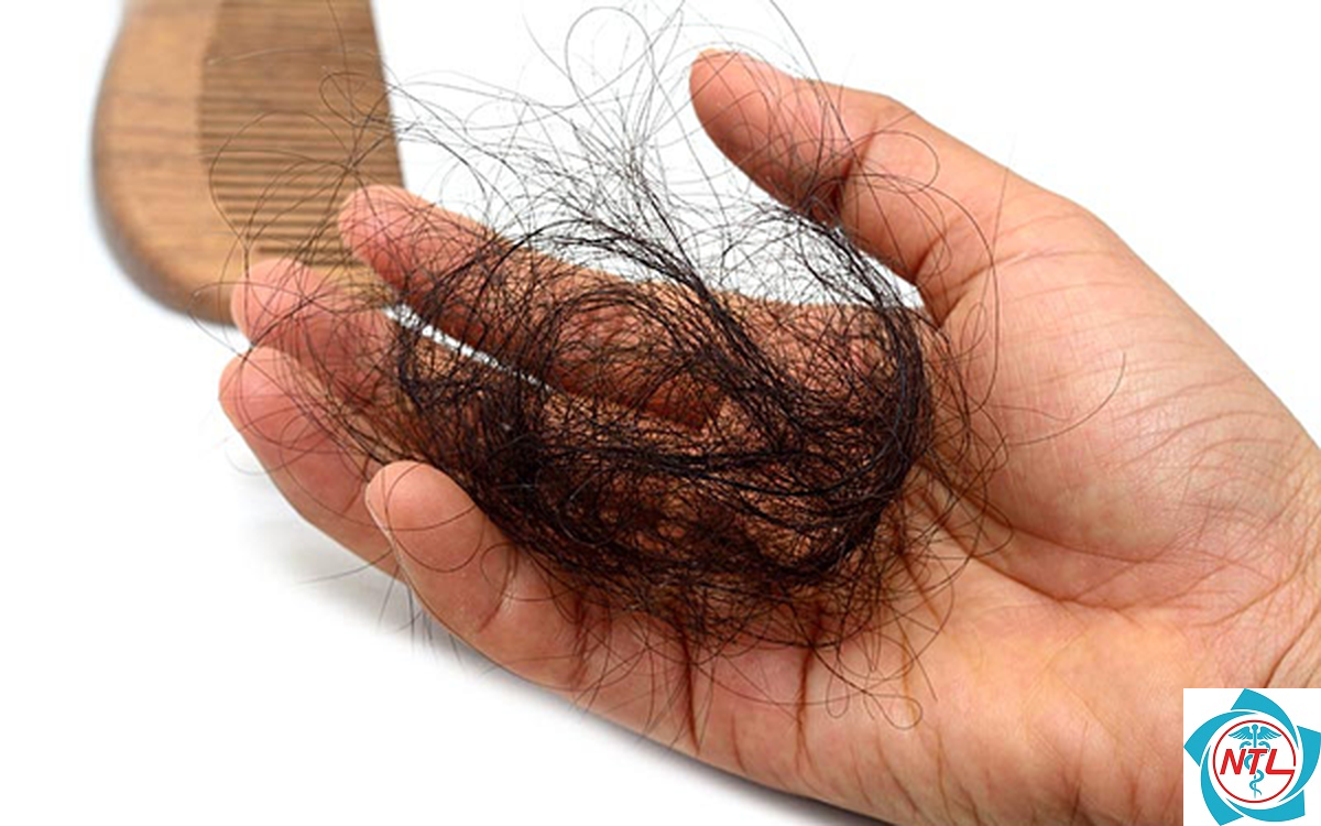 rụng tóc sau sinh ở phụ nữ - Image 2