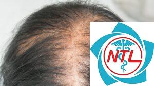 rụng tóc sau sinh ở phụ nữ
