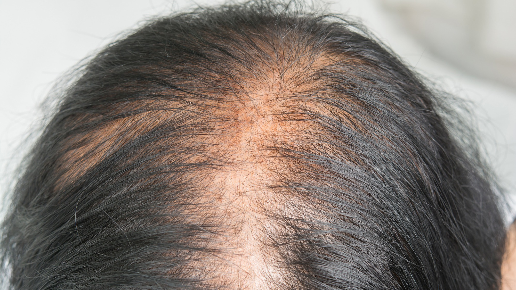 rụng tóc sau sinh - Image 1