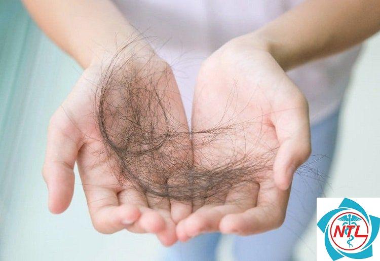 rụng tóc sau sốt - Image 2