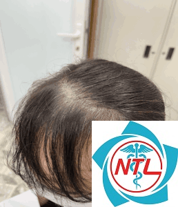 rụng tóc sau sốt